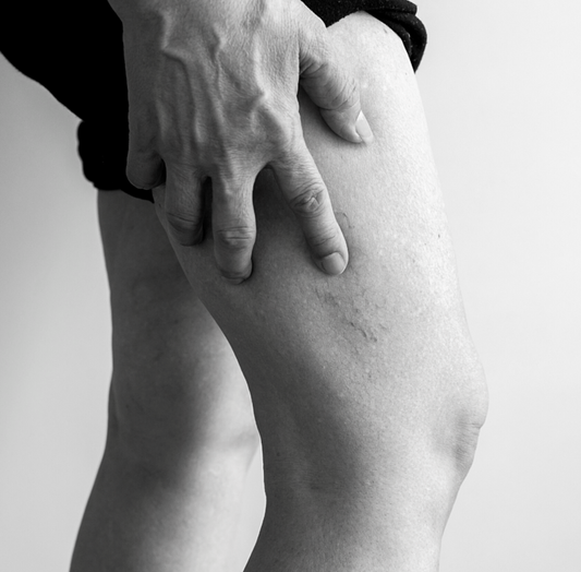 Sclerotherapy Vein Treatment