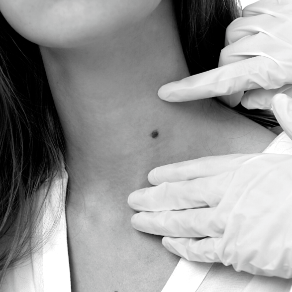 Mole / Skin Tag Removal